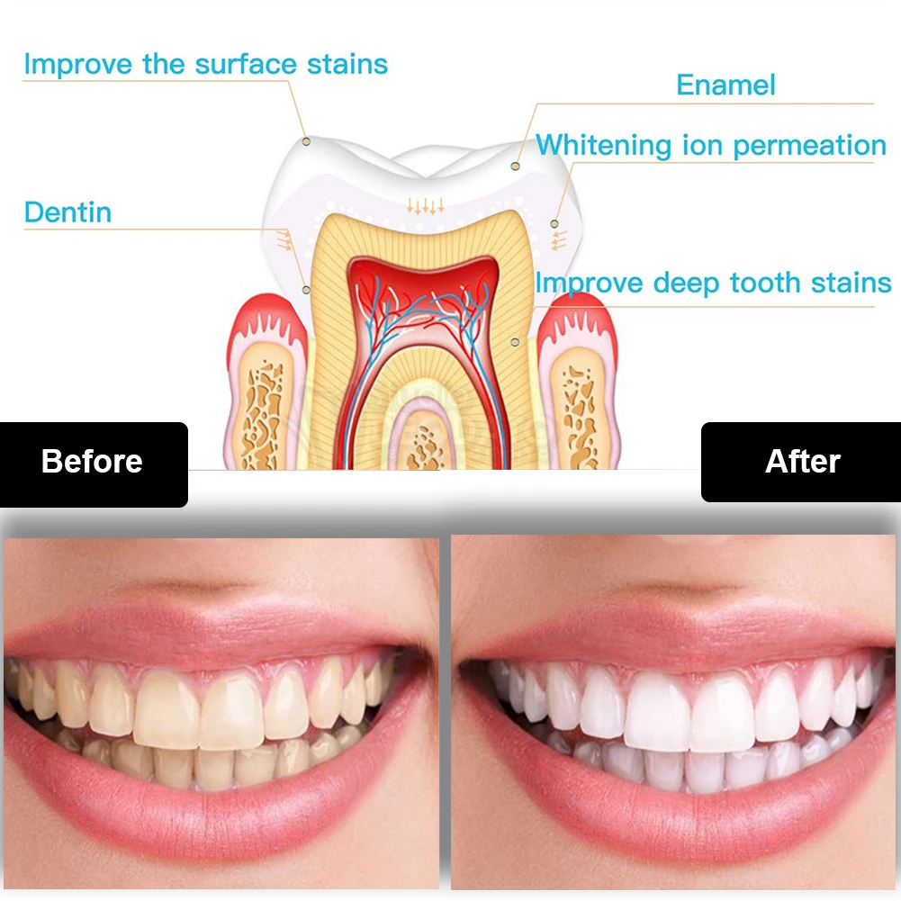 Dental Teeth Whitening Kit Min – Teeth Whitening Device Bewertung und Preis