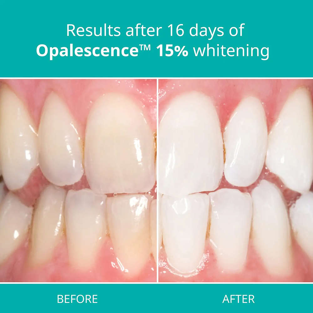 opalescence pf 15% refill kit  – Teeth Whitening Gel Opalescence Bewertung und Preis
