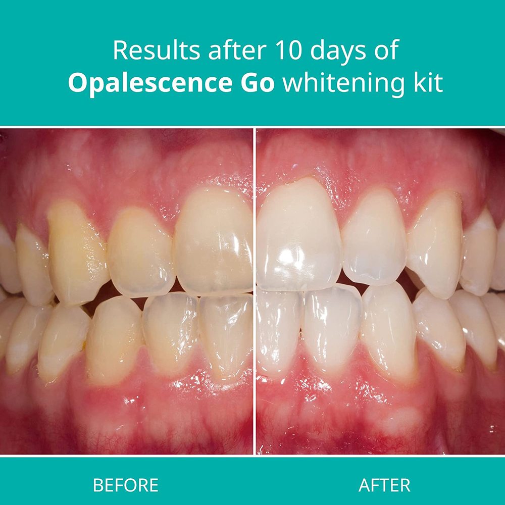 Opalescence Go Teeth Whitening – Teeth Whitening Gel Opalescence Bewertung und Preis